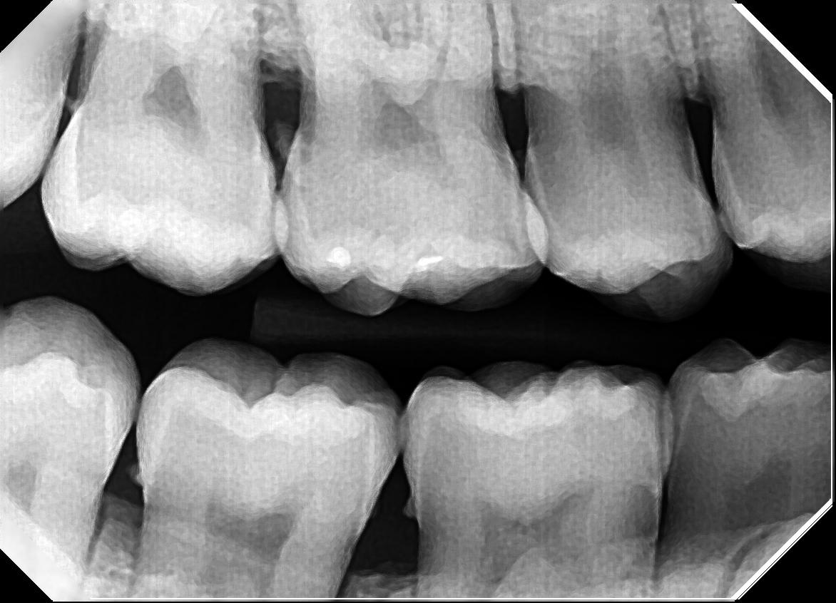 Dentist Lewisville, Flower Mound, Coppell, Carrollton Texas Can I