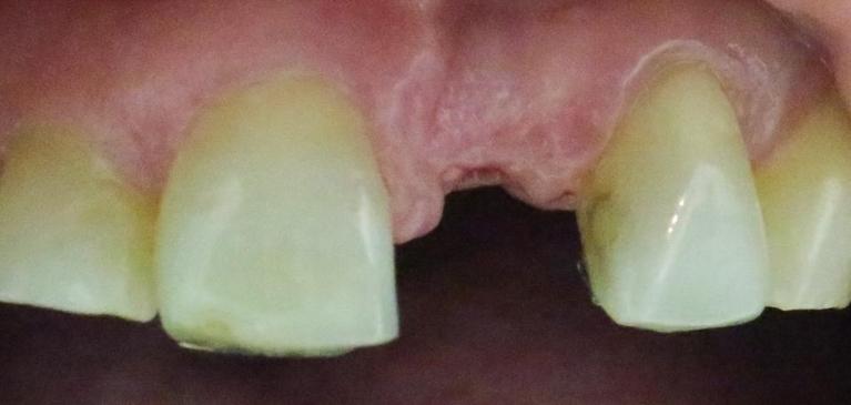 Missing-a-Front-Tooth-Before-Image