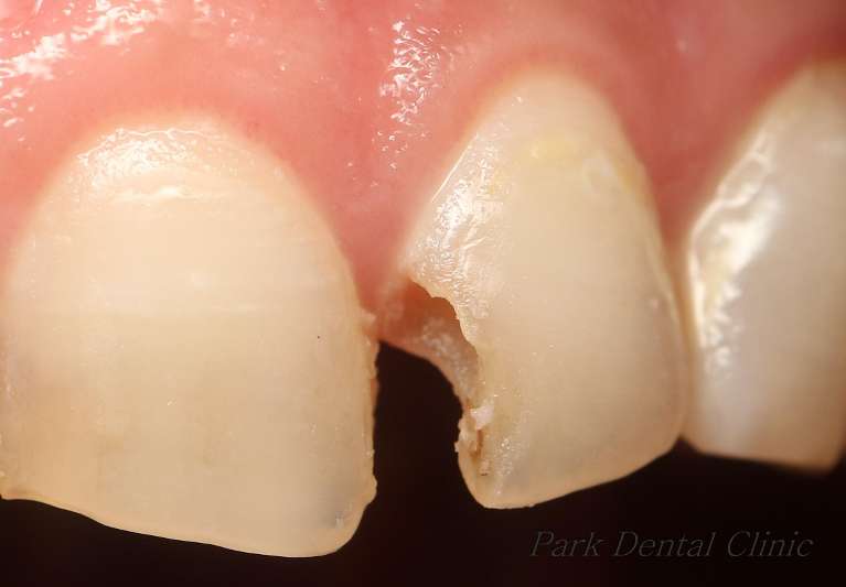 No-more-worry-on-smile-at-least-for-this-tooth-Before-Image